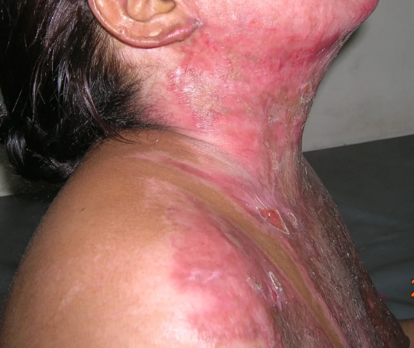 Burns and scar care in Surat