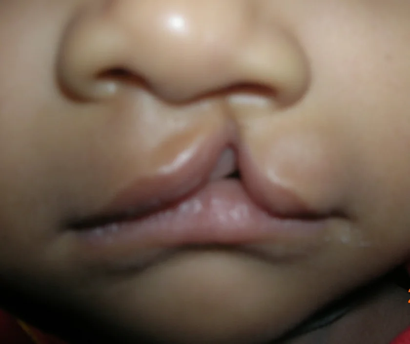 Congenital anomaly correction surgery in Surat