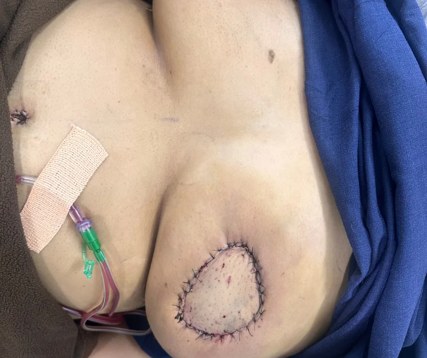 Post-cancer reconstruction after tumour surgery in Surat